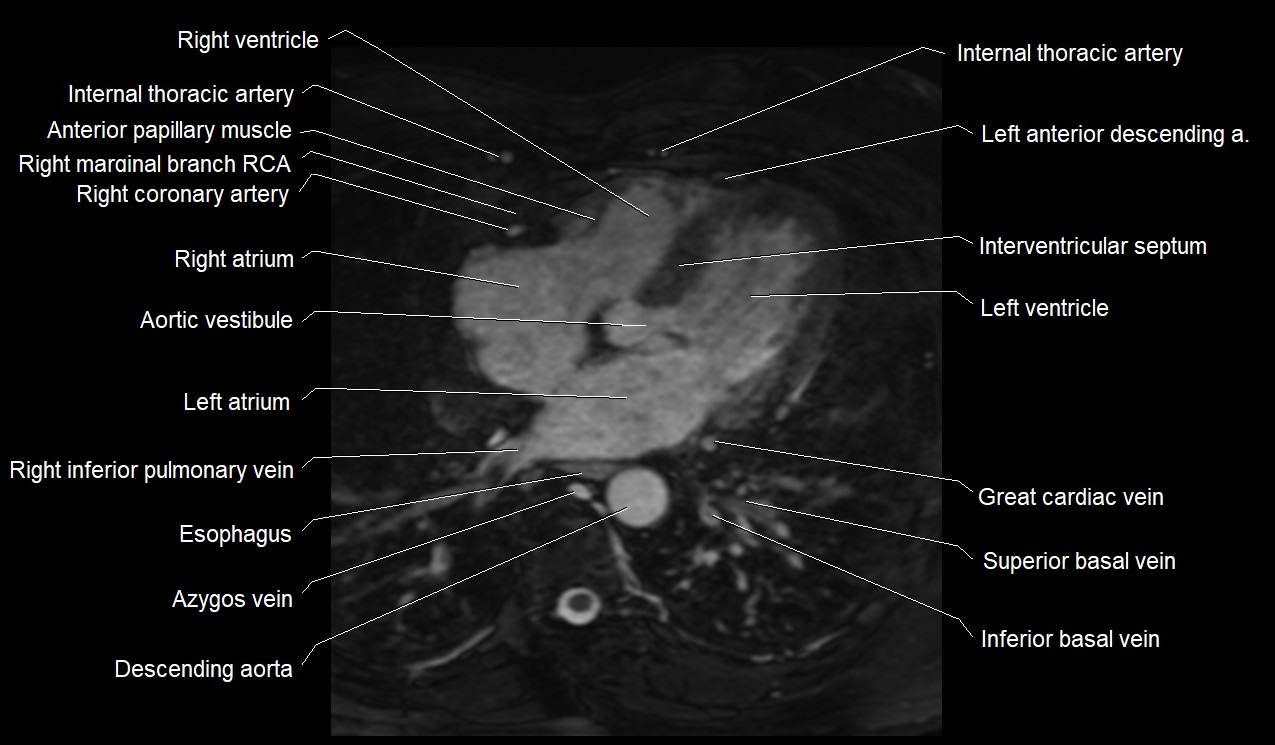 MRI heart coronary arteries and coronary veins anatomy axial image 27.jpg